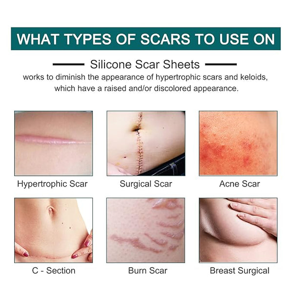 rollo de cinta de silicona para cicatrices (1.5 metros)