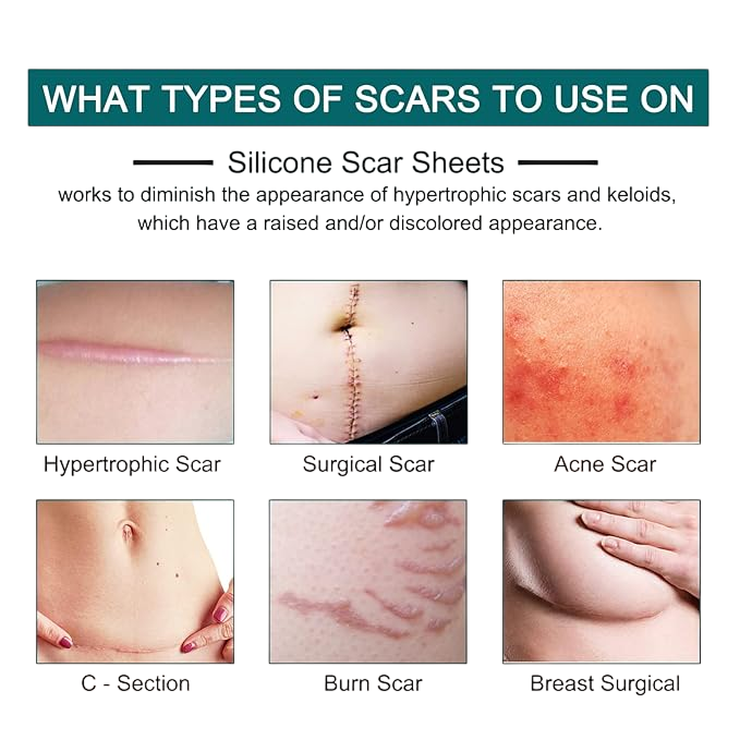 rollo de cinta de silicona para cicatrices (1.5 metros)