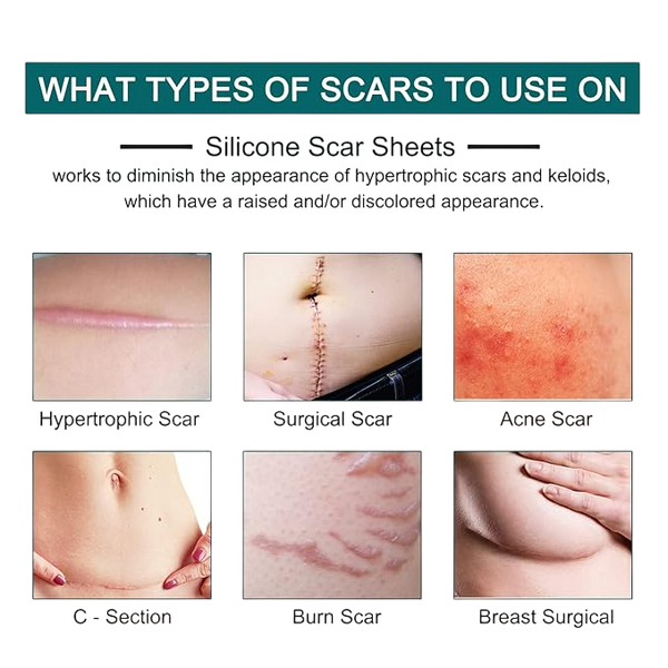 rollo de cinta de silicona para cicatrices (1.5 metros)